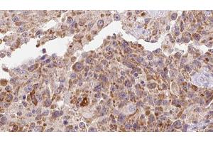 ABIN6273127 at 1/100 staining Human Melanoma tissue by IHC-P. (INHBA 抗体  (Internal Region))