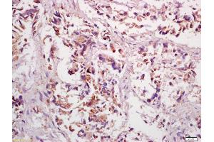 Formalin-fixed and paraffin embedded human gastric cancer labeled with Anti-PPP4C Polyclonal Antibody, Unconjugated (ABIN669261) at 1:200 followed by conjugation to the secondary antibody and DAB staining (PPP4C 抗体  (AA 265-307))