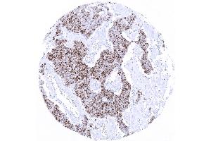 Merkel cell carcinoma with moderate to strong TdT immunostaining in _80 of tumor cells. (Recombinant TdT 抗体)