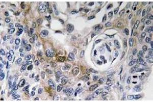 Immunohistochemistry analysis of CD63 antibody in Paraffin-Embedded Human lung carcinoma tissue. (CD63 抗体)