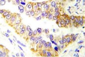 Immunohistochemistry (IHC) analyzes of Tsc2 antibody in paraffin-embedded human lung carcinoma tissue. (Tuberin 抗体)