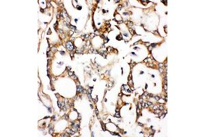 Anti-ALDH2 antibody, IHC(P) IHC(P): Human Liver Cancer Tissue (ALDH2 抗体  (N-Term))