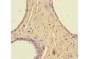 Immunohistochemistry of paraffin-embedded human prostate cancer using ABIN7168135 at dilution of 1:100 (RAVER2 抗体  (AA 2-691))
