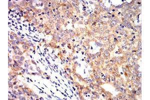 Immunohistochemical analysis of paraffin-embedded breast cancer tissues using KRT10 mouse mAb with DAB staining. (Keratin 10 抗体  (AA 345-454))