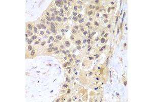 Immunohistochemistry of paraffin-embedded human lung cancer using PSMC5 antibody at dilution of 1:100 (400x lens). (PSMC5 抗体)