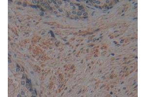 Detection of CRN in Human Prostate Tissue using Polyclonal Antibody to Corin (CRN) (Corin 抗体  (AA 134-573))