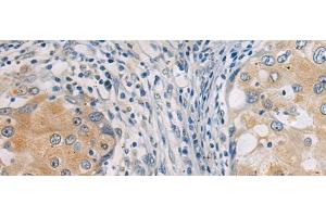 Immunohistochemistry of paraffin-embedded Human breast cancer tissue using GBA Polyclonal Antibody at dilution of 1:55(x200) (GBA 抗体)
