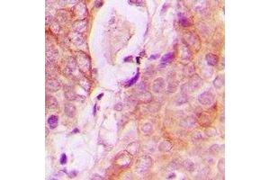 Immunohistochemical analysis of RAB34 staining in human breast cancer formalin fixed paraffin embedded tissue section. (RAB34 抗体  (C-Term))