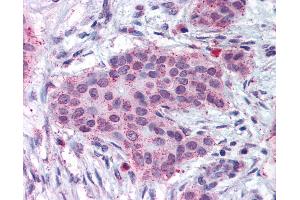 Anti-MMP13 antibody IHC of human breast carcinoma. (MMP13 抗体  (N-Term))
