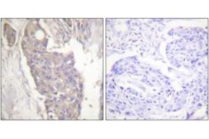 Immunohistochemistry analysis of paraffin-embedded human breast carcinoma tissue, using FAS Antibody. (FAS 抗体  (AA 281-330))