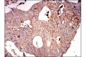 Immunohistochemical analysis of paraffin-embedded rectum cancer tissues using SDC1 mouse mAb with DAB staining.