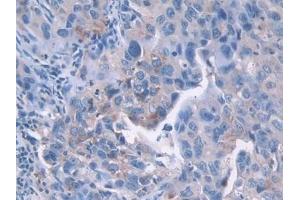 Detection of CDK2 in Human Breast cancer Tissue using Polyclonal Antibody to Cyclin Dependent Kinase 2 (CDK2) (CDK2 抗体  (AA 94-198))