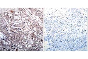 Immunohistochemical analysis of paraffin-embedded human breast carcinoma tissue, using IκB-β (Phospho-Ser23) antibody (E011304). (NFKBIB 抗体  (pSer23))
