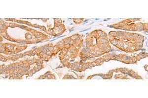 Immunohistochemistry of paraffin-embedded Human thyroid cancer tissue using CYB5D1 Polyclonal Antibody at dilution of 1:45(x200) (CYB5D1 抗体)