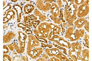 ABIN6260517 and ABIN6277589 at 1/100 staining Human kidney cancer and adjacent normal tissues by IHC-P. (CBR1 抗体  (C-Term))
