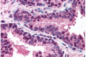Human Prostate (formalin-fixed, paraffin-embedded) stained with TNFRSF10B antibody ABIN213934 at 5-10 ug/ml followed by biotinylated goat anti-rabbit IgG secondary antibody ABIN481713, alkaline phosphatase-streptavidin and chromogen.