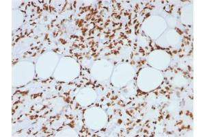 Formalin-fixed, paraffin-embedded human Angiosarcoma stained with Histone H1 Mouse Monoclonal Antibody (AE-4)