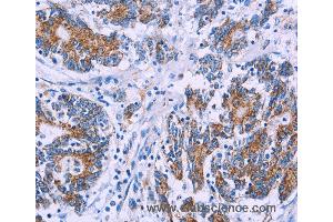 Immunohistochemistry of Human colon cancer using AGFG1 Polyclonal Antibody at dilution of 1:50 (AGFG1 抗体)