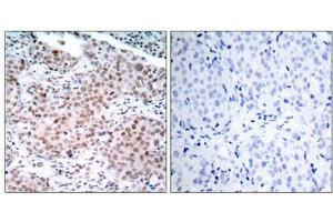 Immunohistochemical analysis of paraffin-embedded human breast carcinoma tissue using Estrogen Receptor-a(Phospho-Ser104) Antibody(left) or the same antibody preincubated with blocking peptide(right). (Estrogen Receptor alpha 抗体  (pSer104))