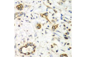 Immunohistochemistry of paraffin-embedded human liver cancer using NRBF2 antibody at dilution of 1:100 (x40 lens). (NRBF2 抗体)