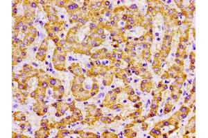 Immunohistochemistry of paraffin-embedded human liver cancer using ABIN7142326 at dilution of 1:100 (MPST 抗体  (AA 102-208))