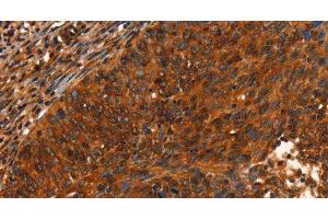 Immunohistochemistry of paraffin-embedded Human cervical cancer using PRKD1 Polyclonal Antibody at dilution of 1:40 (PKC mu 抗体)