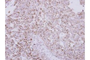 IHC-P Image Immunohistochemical analysis of paraffin-embedded human breast cancer, using Protein C, antibody at 1:250 dilution. (PROC 抗体)