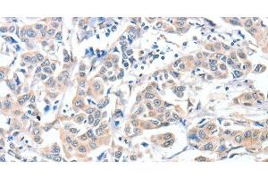 Immunohistochemistry of paraffin-embedded Human breast cancer using CD156c Polyclonal Antibody at dilution of 1:30 (ADAM10 抗体)