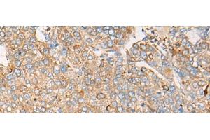 Immunohistochemistry of paraffin-embedded Human liver cancer tissue using CAPN9 Polyclonal Antibody at dilution of 1:45(x200) (Calpain 9 抗体)