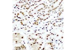 Immunohistochemical analysis of Pontin 52 staining in human gastric cancer formalin fixed paraffin embedded tissue section. (RUVBL1 抗体)