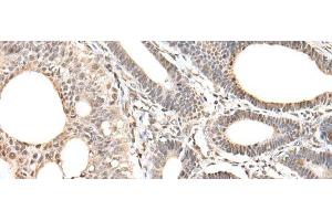 Immunohistochemistry of paraffin-embedded Human gastric cancer tissue using ZNF281 Polyclonal Antibody at dilution of 1:30(x200) (ZNF281 抗体)
