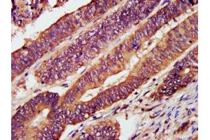 IHC image of ABIN7146103 diluted at 1:1200 and staining in paraffin-embedded human colon cancer performed on a Leica BondTM system. (CXCR3 抗体  (AA 4-50))