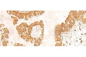 Immunohistochemistry of paraffin-embedded Human liver cancer tissue using POLR1D Polyclonal Antibody at dilution of 1:50(x200) (POLR1D 抗体)