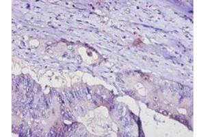 Immunohistochemistry of paraffin-embedded human colon cancer using ABIN7143414 at dilution of 1:100 (ADIPOQ 抗体  (AA 19-244))