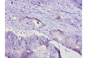 Immunohistochemistry of paraffin-embedded human colon cancer using ABIN7143414 at dilution of 1:100 (ADIPOQ 抗体  (AA 19-244))