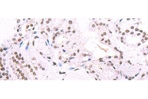Immunohistochemistry of paraffin-embedded Human thyroid cancer tissue using IRF2BP1 Polyclonal Antibody at dilution of 1:40(x200) (IRF2BP1 抗体)