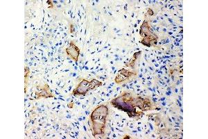 Anti-Bone Sialoprotein antibody, IHC(P) IHC(P): Human Osteosarcoma Tissue (IBSP 抗体  (N-Term))