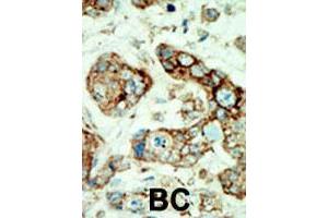 Formalin-fixed and paraffin-embedded human cancer tissue reacted with EPHA2 polyclonal antibody  , which was peroxidase-conjugated to the secondary antibody, followed by AEC staining. (EPH Receptor A2 抗体  (N-Term))