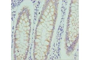 Immunohistochemistry of paraffin-embedded human colon cancer using ABIN7161746 at dilution of 1:100 (NUAK2 抗体  (AA 479-628))
