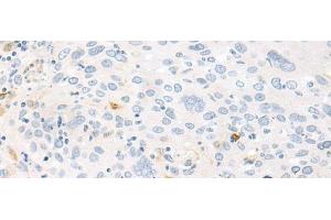 Immunohistochemistry of paraffin-embedded Human cervical cancer tissue using FABP4 Polyclonal Antibody at dilution of 1:60(x200) (FABP4 抗体)