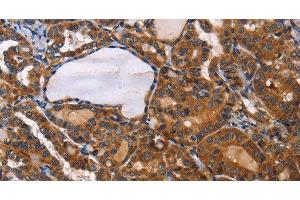 Immunohistochemistry of paraffin-embedded Human thyroid cancer using ILK Polyclonal Antibody at dilution of 1:50 (ILK 抗体)