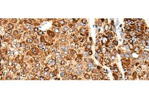 Immunohistochemistry of paraffin-embedded Human liver cancer tissue using CACNG5 Polyclonal Antibody at dilution of 1:50(x200) (CACNG5 抗体)