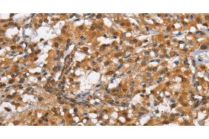 Immunohistochemistry of paraffin-embedded Human thyroid cancer tissue using CD13 Polyclonal Antibody at dilution 1:80 (CD13 抗体)