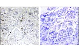Immunohistochemistry analysis of paraffin-embedded human breast carcinoma tissue, using BATF Antibody. (BATF 抗体  (AA 10-59))