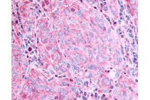 Anti-GPR45 antibody IHC of human Skin, Melanoma. (GPR45 抗体  (Cytoplasmic Domain))