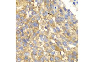 Immunohistochemistry of paraffin-embedded human esophageal cancer using EIF2AK4 antibody (ABIN5974303) at dilution of 1/100 (40x lens). (GCN2 抗体)