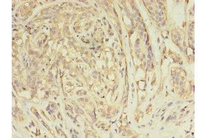 Immunohistochemistry of paraffin-embedded human breast cancer using ABIN7144576 at dilution of 1:100 (ARFIP2 抗体  (AA 20-295))