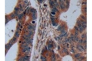 Detection of C2CD3 in Human Colorectal cancer Tissue using Polyclonal Antibody to C2 Calcium Dependent Domain Containing Protein 3 (C2CD3) (C2CD3 抗体  (AA 1432-1647))