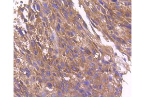 Paraformaldehyde-fixed, paraffin embedded human breast cancer, Antigen retrieval by boiling in sodium citrate buffer (pH6) for 15min, Block endogenous peroxidase by 3% hydrogen peroxide for 30 minutes, Blocking buffer at 37°C for 20min, Antibody incubation with ARF1 (1D4) Monoclonal Antibody  at 1:50 overnight at 4°C, followed by a conjugated secondary and DAB staining. (ARF1 抗体)