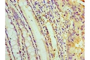 Immunohistochemistry of paraffin-embedded human colon cancer using ABIN7166888 at dilution of 1:100 (PYCR1 抗体  (AA 2-319))